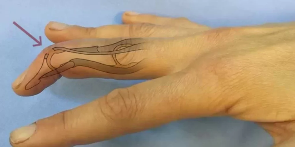 mallet finger 1