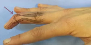 Mallet finger injury showing a drooping fingertip with an overlay diagram of a torn tendon at the distal phalanx.